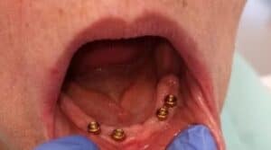 Uzupełnienie brakujących zębów na implantach